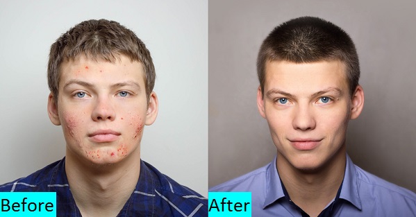 Pimples Treatment in Pune