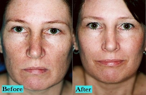 best-CO2-Laser-peels-treatment-doctor-in-pune-india