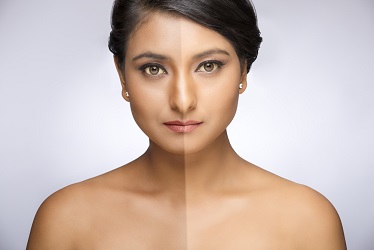 best-skin-pigmentation-laser-treatment-in-pune