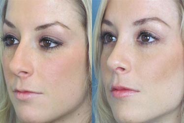 best-rhinoplasty-surgery-treatment-in-pune-india