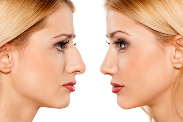 best-rhinoplasty-surgery-treatment-in-pune-india