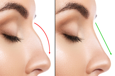 best-rhinoplasty-surgery-treatment-in-pune-india