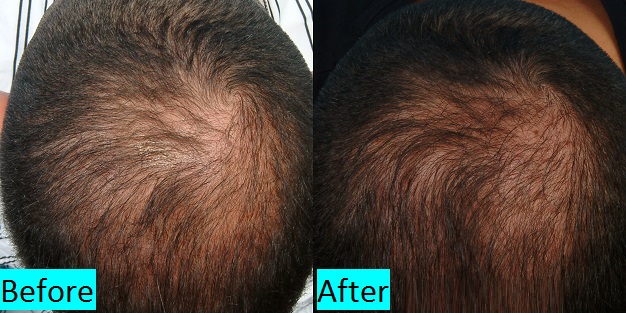 alopecia-areata-cure-in-pune