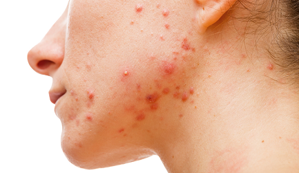 Best Acne Treatment in Pune