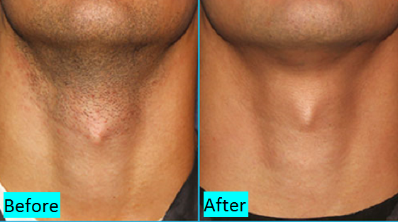 beard-shaping-in-pune