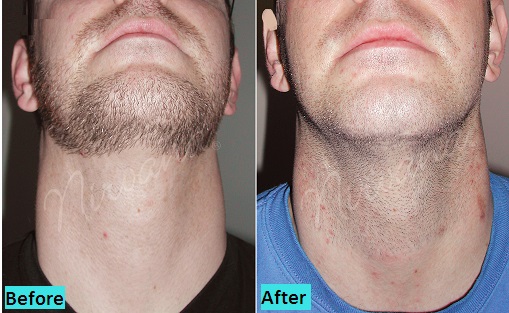 beard-shaping-in-pune