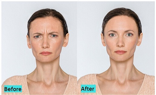 best-botox-and-fillers-treatment-in-pune