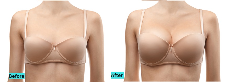 best-breast-impants-in-pune