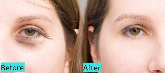 best dark circle treatment clinic in pune