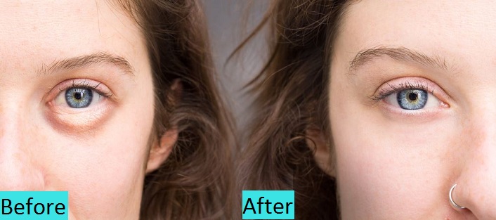 best dark circle treatment clinic in pune