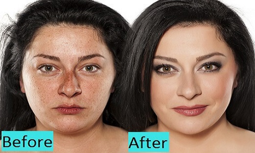 freckles-sunspots-treatment-in-koregaon-park-pune