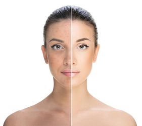 best-glutathione-skin-lightening-injections-in-pune