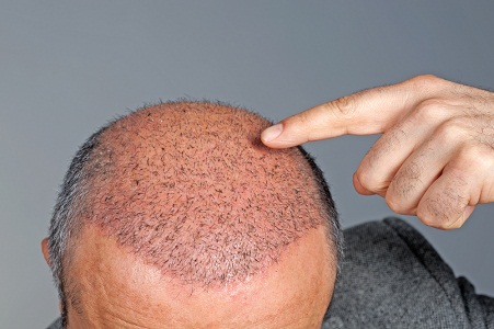 Hair Transplant in Pune