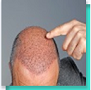 Hair Transplant