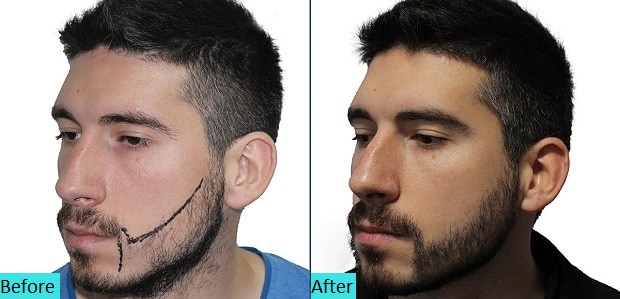 best-fue-hair-transplant-results-at-skin-world-pune-india