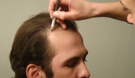 best-fue-hair-transplant-in-pune-india