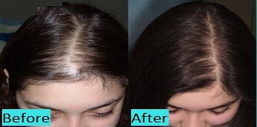 Best Hair Transplant Pune India