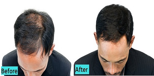 Best Hair Transplant Pune India