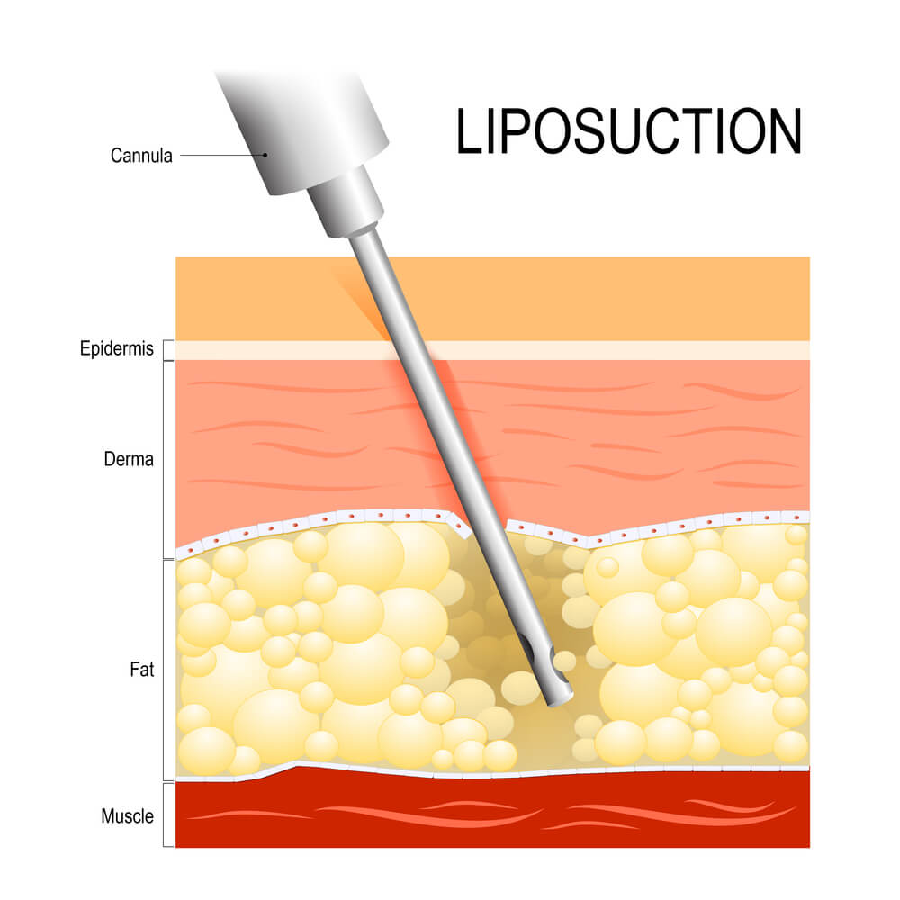 best-liposuction-treatment-in-pune