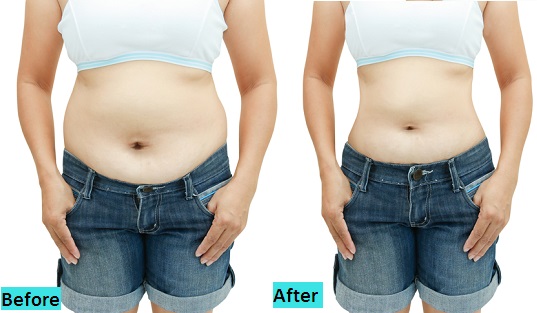 best-liposuction-treatment-in-pune