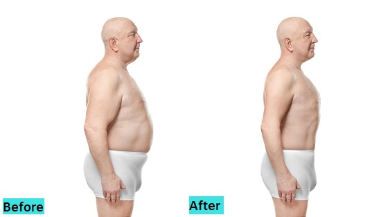 best-liposuction-treatment-in-pune