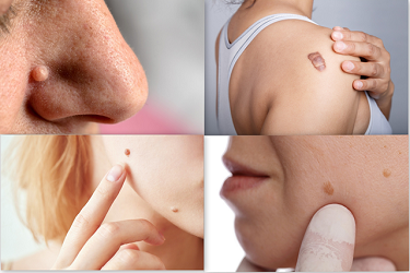 best-moles-warts-keloids-skin tags-treatment-in-pune