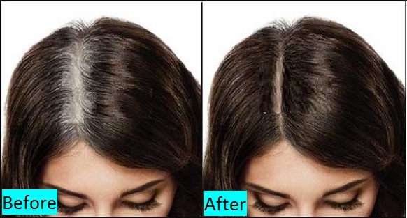 premature-graying-treatment-in-pune-india