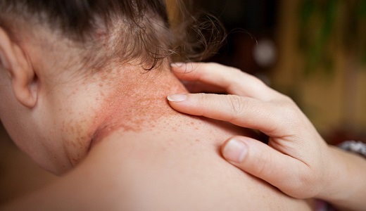 best-stretch-marks-treatment-in-pune