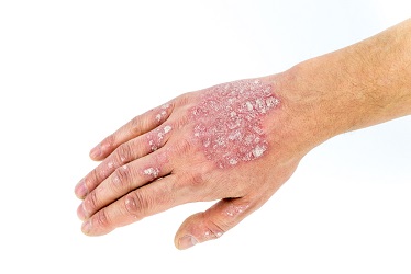 Psoriasis-skin-Treatment-in-pune