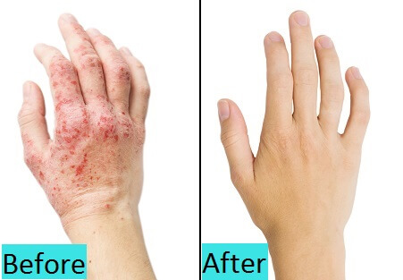 best psoriasis treatment in pune