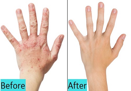 best psoriasis treatment in pune