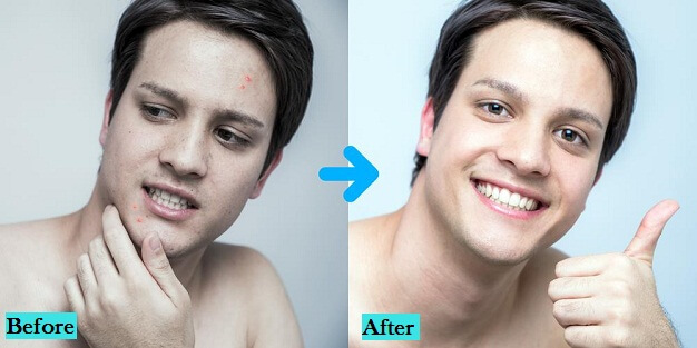 best-scar-treatment-in-pune-india