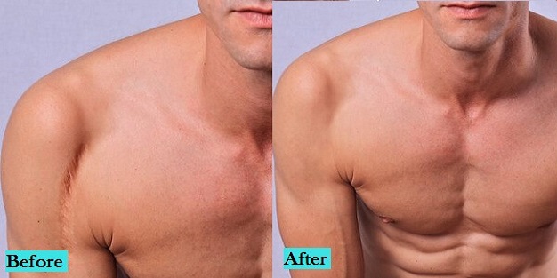 best-scar-treatment-in-pune-india