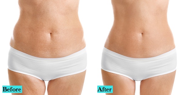 best-stretch-marks-treatment-in-pune