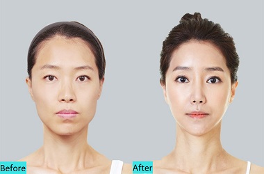 best-V-Shape-Face-lift-Treatment-in-pune