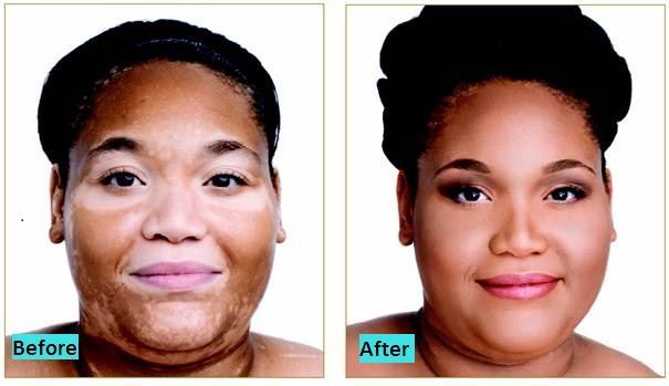 best-vitiligo-surgery-clinic-in-pune-india